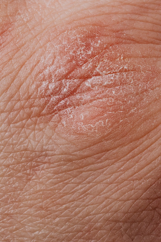 Eczema and Allergies